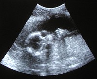 Ultrasound