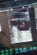 Kůzle na ultrazvuku.